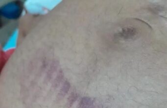 Mulher grávida é agredida e perde o bebê após confusão na cavalgada de Buritirana