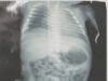 Bebê atingido por tiro ainda dentro do útero da mãe vai passar por cirurgia em Imperatriz