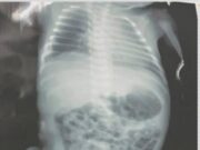 Bebê atingido por tiro ainda dentro do útero da mãe vai passar por cirurgia em Imperatriz