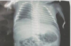 Bebê atingido por tiro ainda dentro do útero da mãe vai passar por cirurgia em Imperatriz